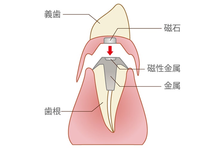 磁石義歯（マグネットデンチャー）の構造